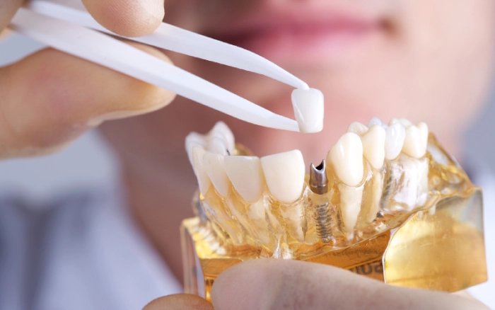 Dental Implant Costs in Turkey (2025 Guide) | Quality & Prices